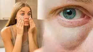 Health Tips-  सुबह उठते ही आंखों में सूजन आ जाती हैं, कहीं ये बड़ी बीमारी का संकेत तो नहीं, जानिए