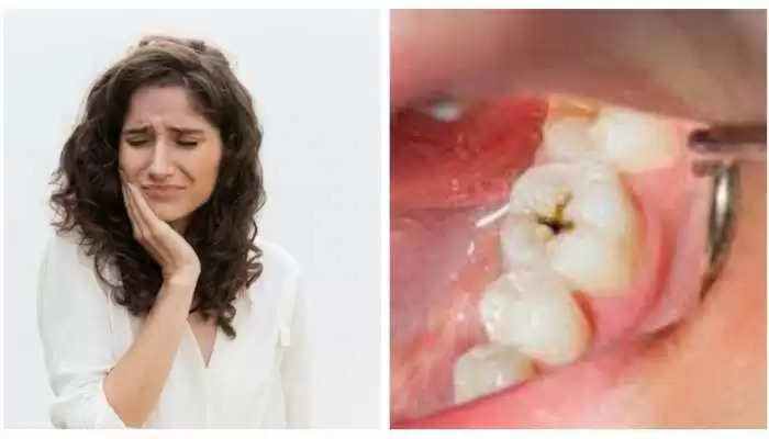 Health Tips- दांतो की इस समस्या का ना करें नजरअंदाज, हो सकता हैं कैंसर